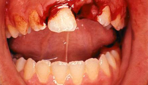 Nieuwegeiner verliest tanden bij gevecht in IJsselstein